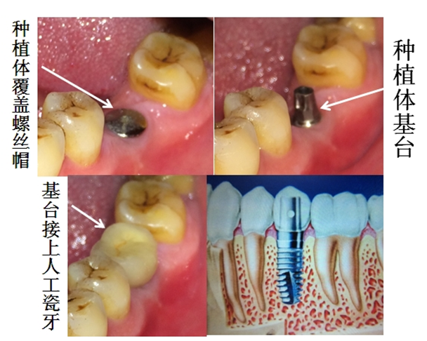假的牙齒多少錢一顆