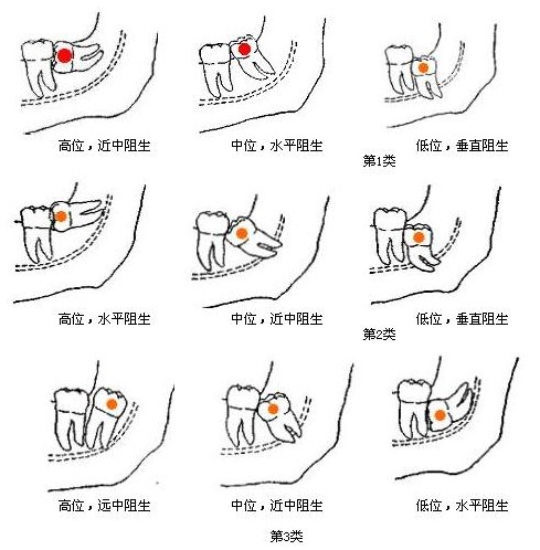 拔牙多少錢