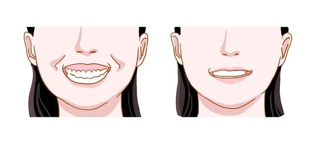 牙齒深覆合矯正