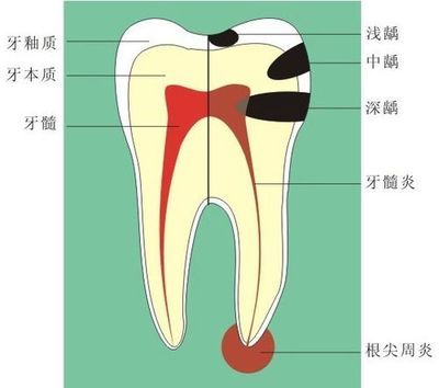 根尖周炎的症狀