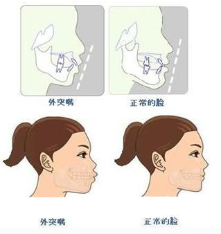 牙齒外突怎麽(me) 辦