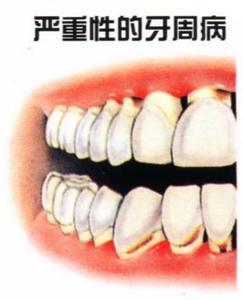 牙齦萎縮