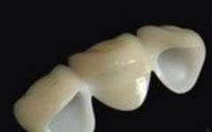 二氧化鋯烤瓷牙的價(jia) 格