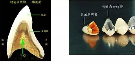 鎳鉻合金烤瓷牙影響做核磁共振嗎