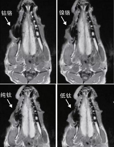 鎳鉻合金烤瓷牙對核磁共振有影響嗎
