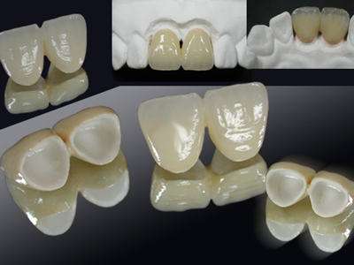 烤瓷牙一般能用多久