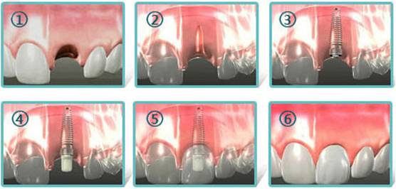 一般種植牙需要幾次才能做好