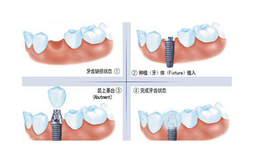 深圳種牙一顆多少錢