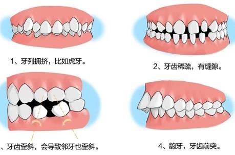 箍牙齒要多少錢