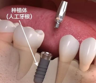 人工種植牙好嗎