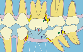 牙齒缺失怎麽(me) 修複