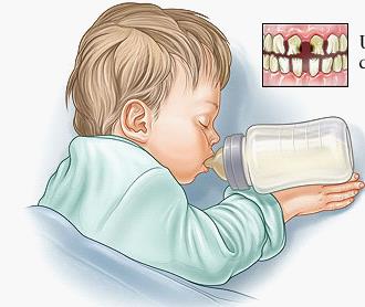 奶瓶齲齒怎麽(me) 辦