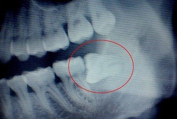 智齒冠周炎治療