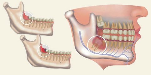 智齒發炎怎麽(me) 辦