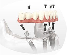 all on 4全口種植牙