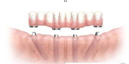all on 4全口種植牙技術