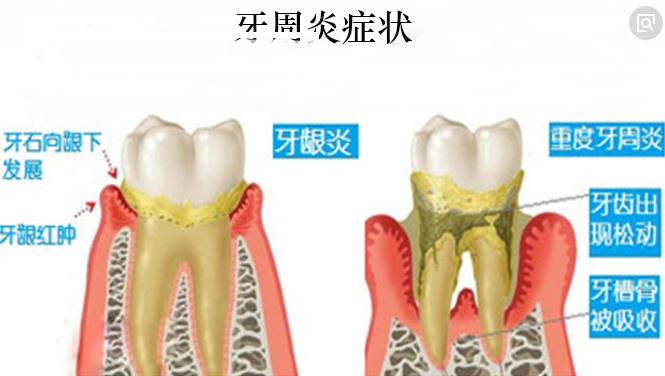 洗牙可以治療牙周炎嗎