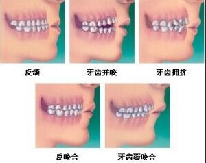 牙齒矯正時間為(wei) 什麽(me) 那麽(me) 長