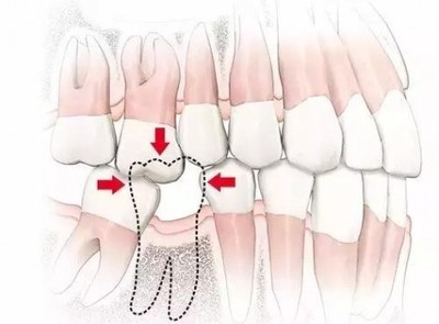 老年人缺一顆牙不要緊