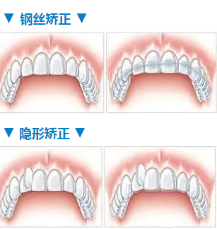 牙齒矯正不拔牙好嗎