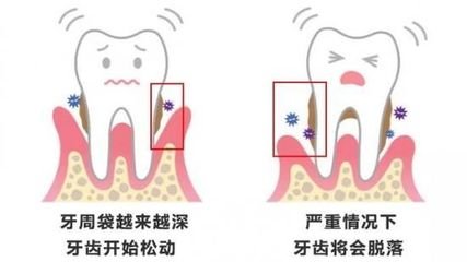 牙根暴露怎麽(me) 辦