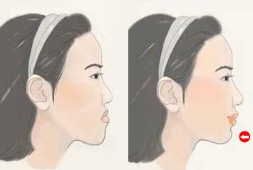 牙齒矯正真的可以改變臉型嗎