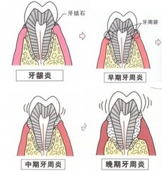 牙周炎會(hui) 不會(hui) 傳(chuan) 染