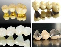 做烤瓷牙多少錢