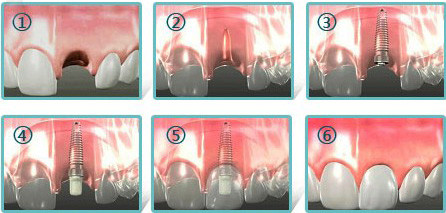 一顆種植牙多少錢
