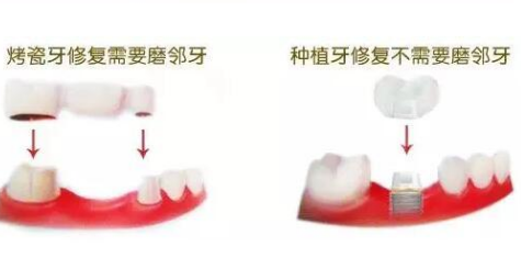 種植牙哪裏便宜