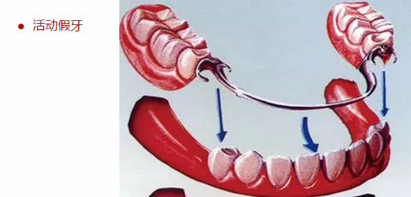 牙齒缺失怎麽(me) 辦