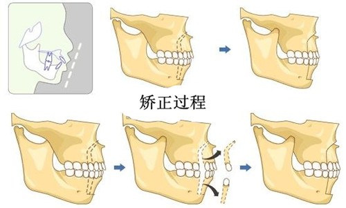 正牙手術多少錢