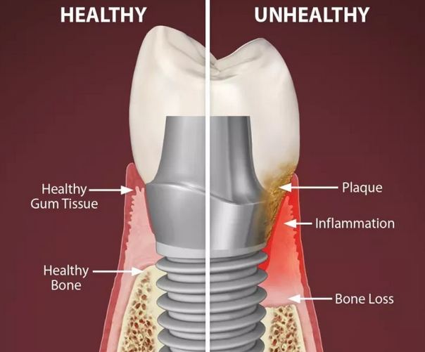 種植牙為(wei) 什麽(me) 會(hui) 鬆動