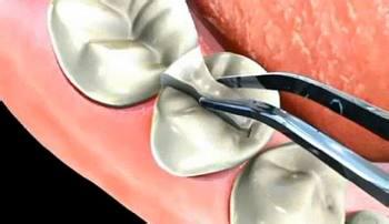 深圳兒(er) 童補牙多少錢