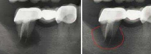 補牙時拍X光片對身體(ti) 有害嗎