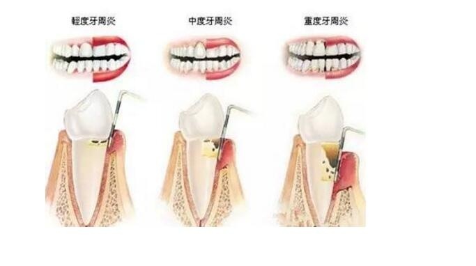 牙周炎牙齦萎縮吃什麽(me) 藥好