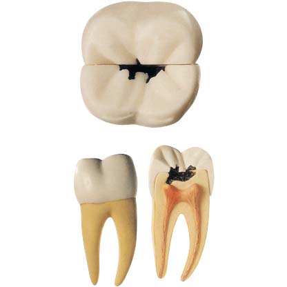 蛀牙腫痛怎麽(me) 辦