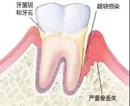 怎樣治療牙菌斑