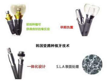 登騰種植體(ti) 價(jia) 格