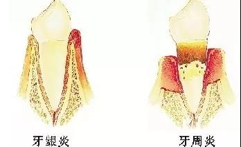 牙齦炎和牙周炎的區別