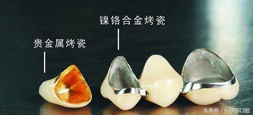 金屬烤瓷牙有毒嗎