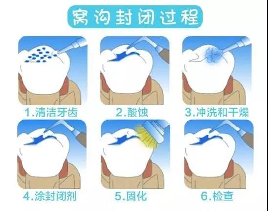 窩溝封閉價(jia) 格
