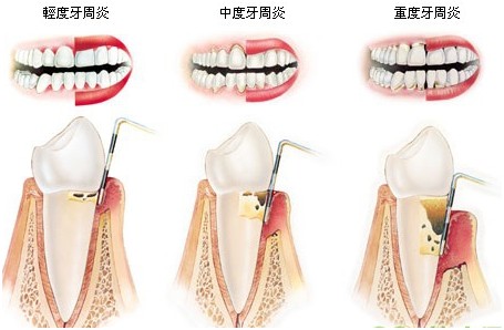 牙周炎的症狀