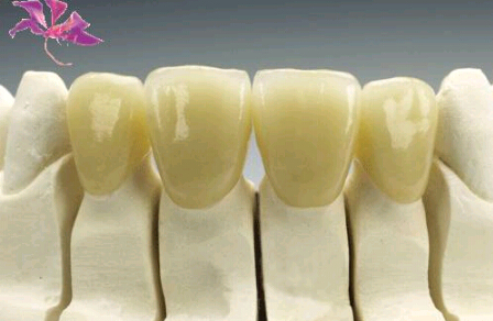 烤瓷牙的材料