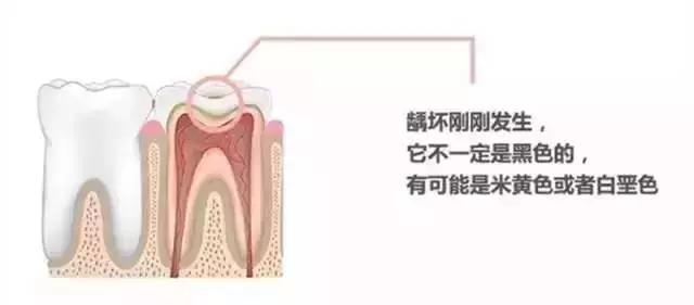 補牙需要多長時間