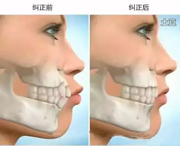 齙牙矯正之前和矯正之後