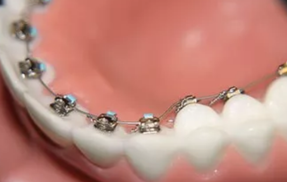 舌側(ce) 隱形矯正
