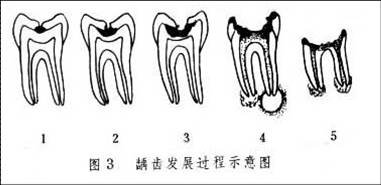 蟲牙怎麽(me) 辦