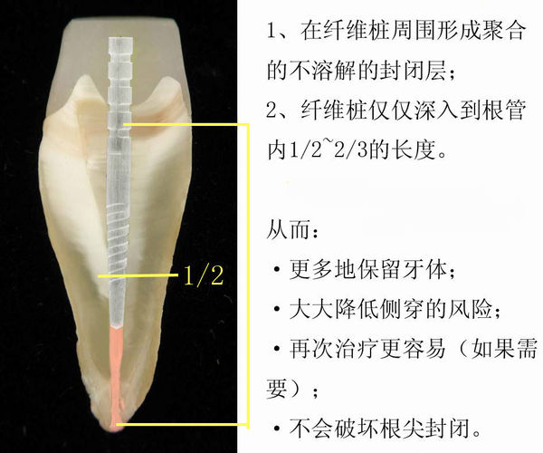 纖維樁和金屬樁的區別