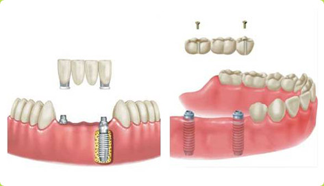 多顆牙齒缺失怎麽(me) 選擇修複方式